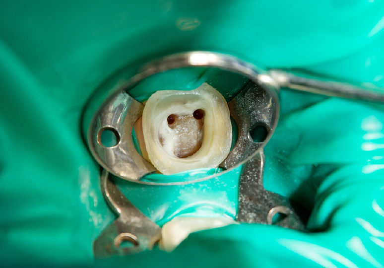 歯を抜くと言われた方当院の精密根管治療なら歯を残せる可能性があります