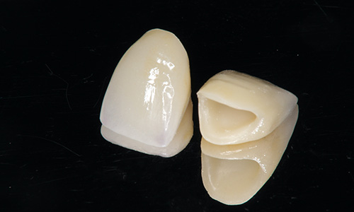 Merit01 天然歯に近い審美性を再現できる