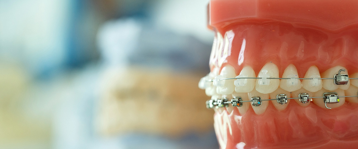 歯並びや噛み合わせを改善する矯正歯科